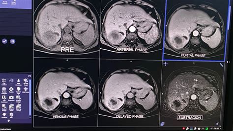 Triphasic Mri Abdomen Liver Abscess In Segment Vii Youtube