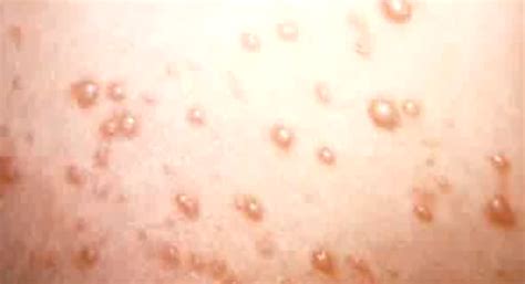 Hiv Rash Images Symptoms Location And Treatment Hubpages