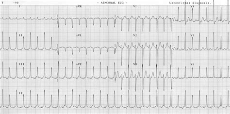 Preexcitation Syndromes Litfl Ecg Library Diagnosis