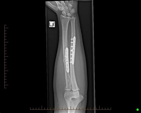 Forearm Fractures Adfrac