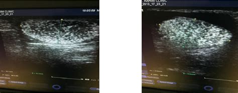 Figure 1 From The Scrotal Colour Doppler Ultrasound Findings In