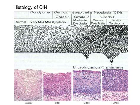 Cervical Cancer Histology