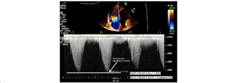 Pulmonary Artery Systolic Pressure PASP Calculated From A Tricuspid