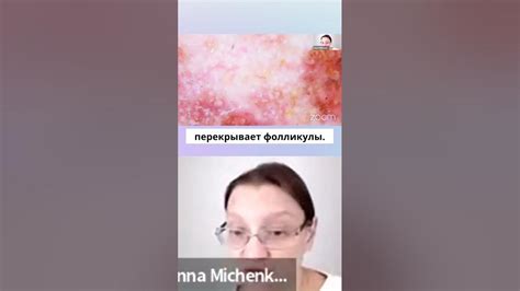 Лентиго меланома часть 2 - YouTube