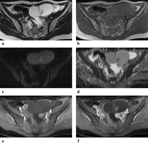 Sbt Mp In 36 Year Old Woman Axial T2wi A Shows Multilocular Cyst