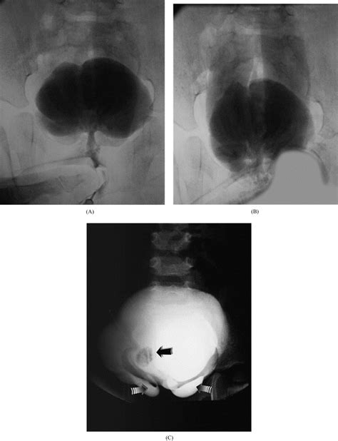 Augmentation Ureterocystoplasty In Bladder Exstrophy 5 Year Follow Up