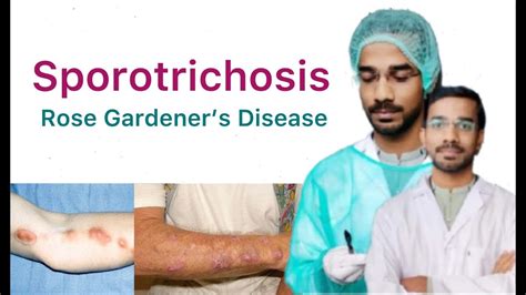 Sporotrichosis Rose Gardener S Disease Subcutaneous Mycosis YouTube