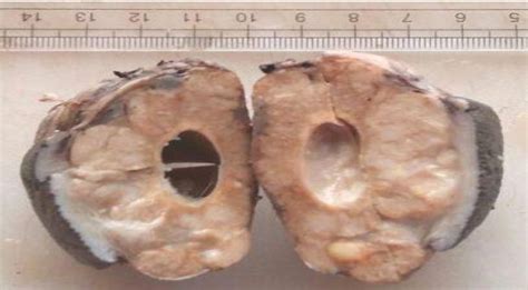 Figure From Disseminated Subcutaneous Rhinosporidiosis Masquerading