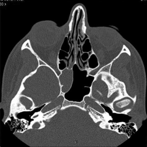 Pdf Differential Diagnosis And Treatment Of Isolated Pathologies Of The Sphenoid Sinus