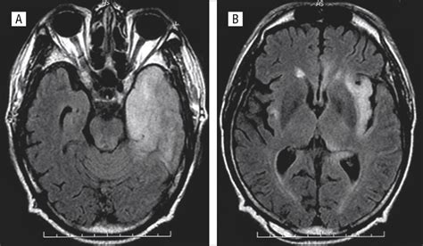 Hsv Encephalitis Mri Herpes Simplex Encephalitis Image