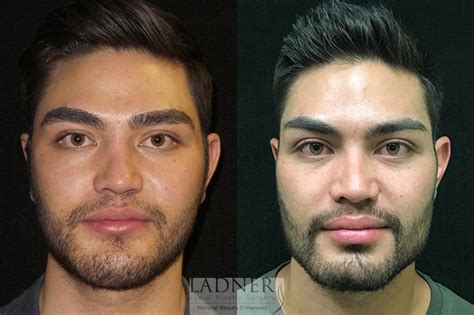 Buccal Fat Removal Denver Co Ladner Plastic Surgery