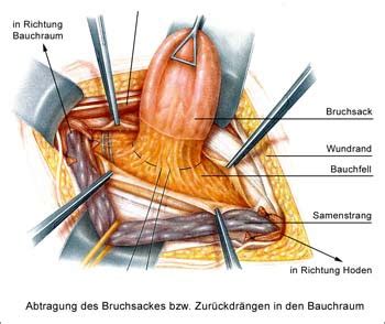 Leistenbruch Mvz Dr Philipp Zollmann Und Kollegen