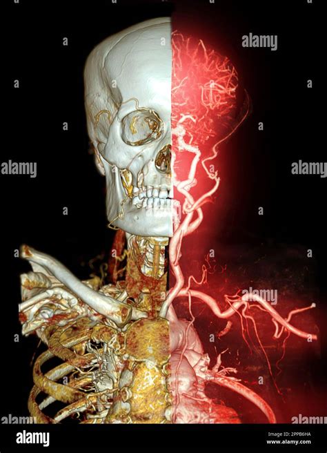 Cta Gehirn Und Arteria Carotis Oder Ct Angiographie Des Gehirns D