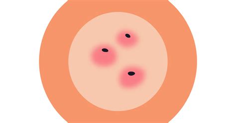 Blackheads Causes And Effective Treatments Ova Sg