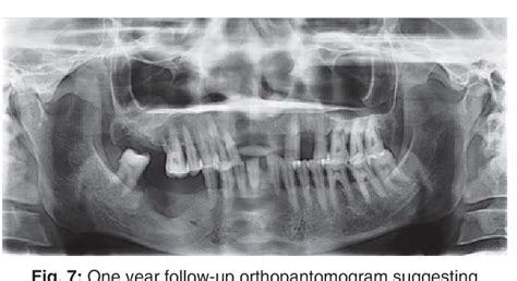 Figure 1 From Management Of Infected Radicular Cyst By Marsupialization Semantic Scholar