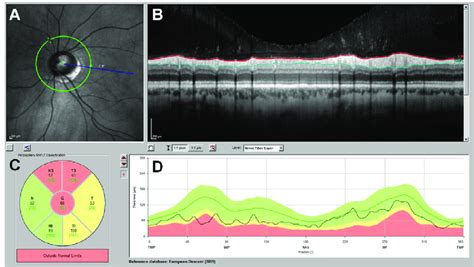 Peripapillary Oct Scan Captured Using Spectralis Oct Heidelberg