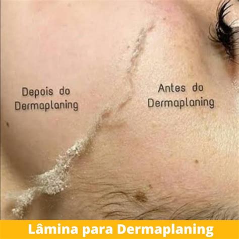 Kit Dermaplaning L Mina N Afiada Cabo Bisturi N Parcelamento