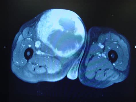 Soft Tissue Neoplasm 4244 Thigh Soft Tissue Sarcoma Mfh 5 | Surgery Photos