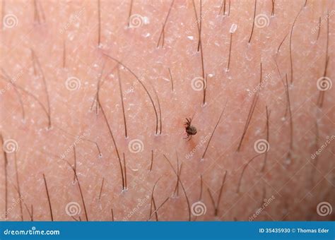 Tick On Skin With Hair Stock Photo Image Of Education 35435930
