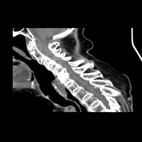 Spinal Epidural Hematoma – Core EM