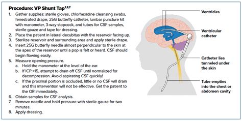 Ventriculoperitoneal Shunt In The ED EMRA