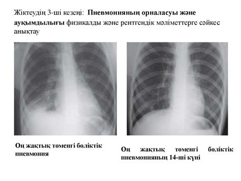 Пневмониялар. Классификациясы, диагностикасы, емі (мәселелік дәріс ...