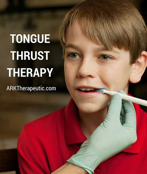 Tongue Thrust Therapy - ARK Products, LLC