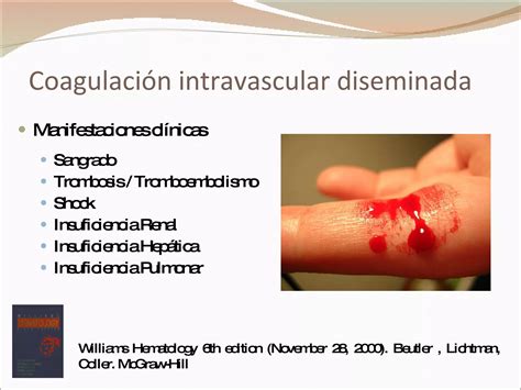 Coagulacion Intravascular Diseminada PPT