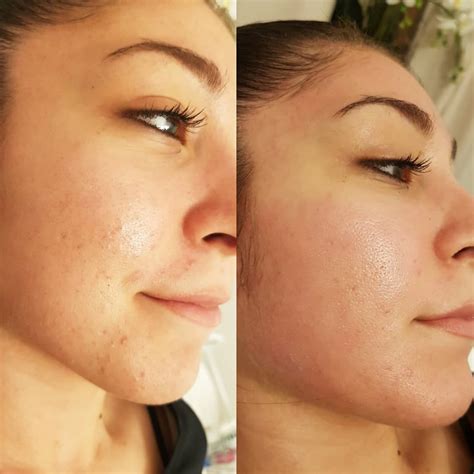 Quels Sont Les Avantages Du Microneedling Mk Skin Beauty