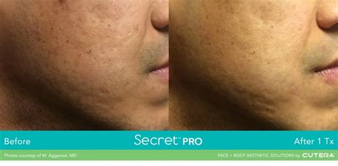 Radiofrequency Microneedling Secretpro Vs Morpheus8 Skin Science Clinic