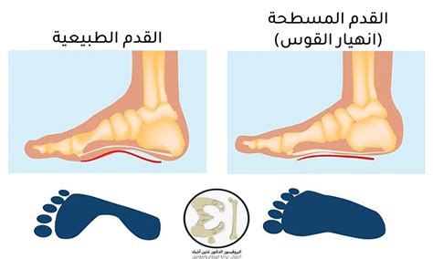 تشخيص وعلاج القدم المسطحة د شتين اشيك