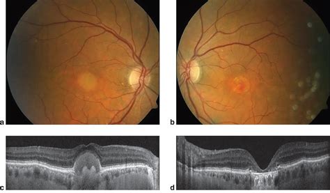 Adult Onset Foveomacular Vitelliform Dystrophy American Academy Of Ophthalmology