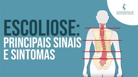 Escoliose Principais Sinais E Sintomas YouTube