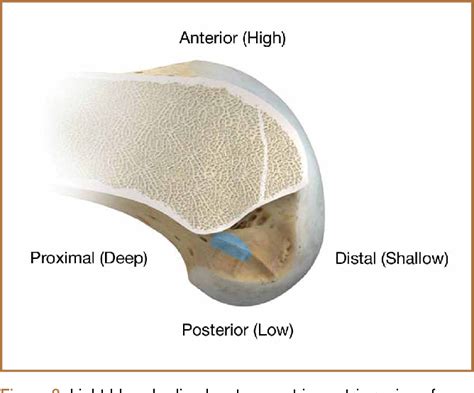 Figure 1 From Rationale For Strategic Graft Placement In Anterior