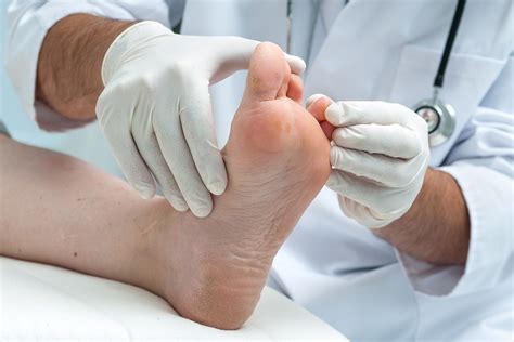 Diabetes And Feet Diabetic Foot Diagnosis Apollo Sugar Clinics