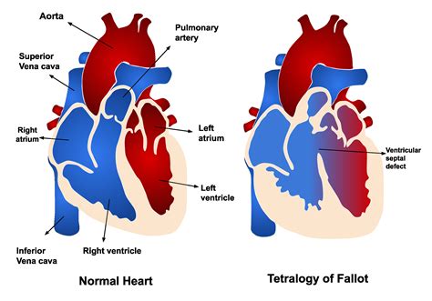 O Que é Tetralogia De Fallot SAVAEDU