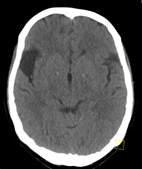 Left-sided hemiparesis - MDCT.net