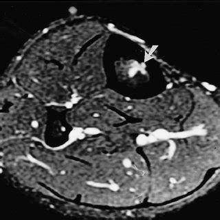 Axial Post Gd DTPA Fat Saturated Spin Echo T 1 Weighted MR Image Of