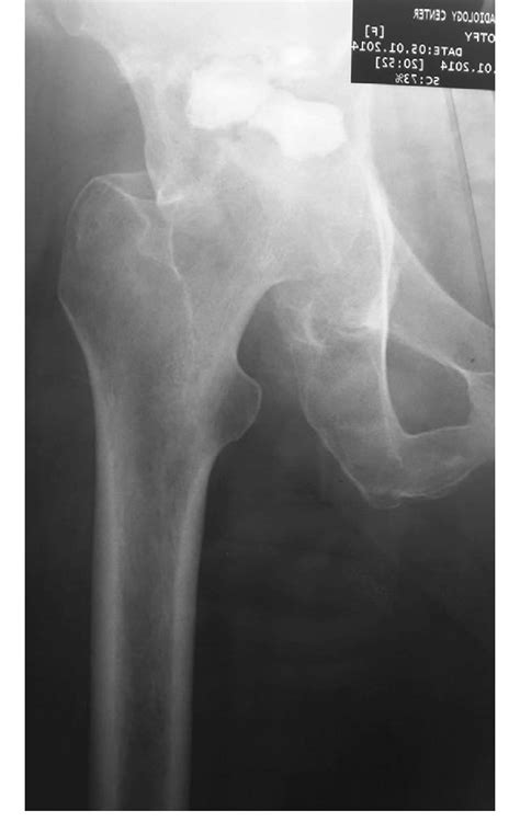 Male 52 Yrs Old Metastatic Hcc To The Right Acetabular Roof Procedure