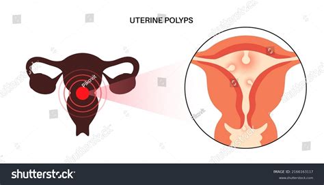 Uterine Polyps Anatomy Endometrial Disease Overgrowth Stock Vector