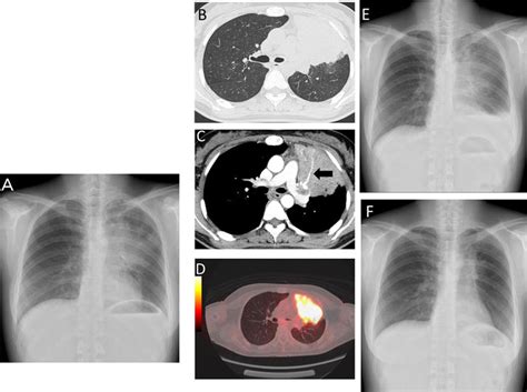 A Chest X Ray A And Ct B C Scan At The Initial Visit Revealed Download Scientific Diagram