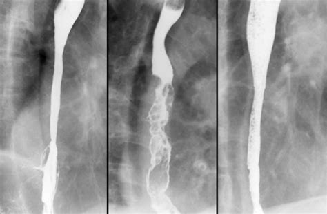 Normal Barium Swallow Anatomy