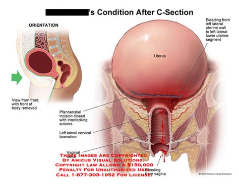 AMICUS Illustration Of Amicus Injury Uterus Vagina Vaginal Bleeding