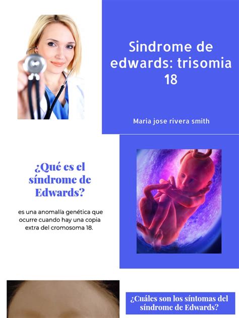 Sindrome de Edwards | PDF