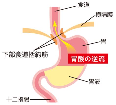 逆流性食道炎の症状｜胃カメラ検査による識別診断ができる川口市のめぐみクリニック｜ct検査にも対応