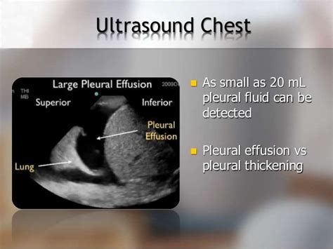 Diagnosing pleural effusion