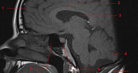 Magnetic Resonance Imaging MRI Of The Turcic Sella Pituitary Gland