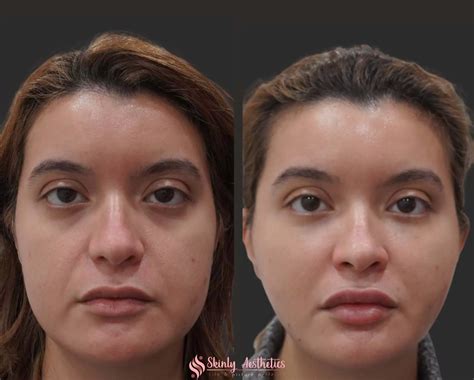 Cheek Fillers Before And After Results At Skinly