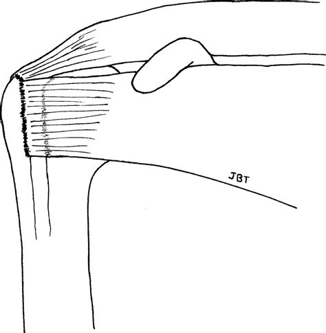 Why Repair The Subscapularis A Logical Rationale Arthroscopy