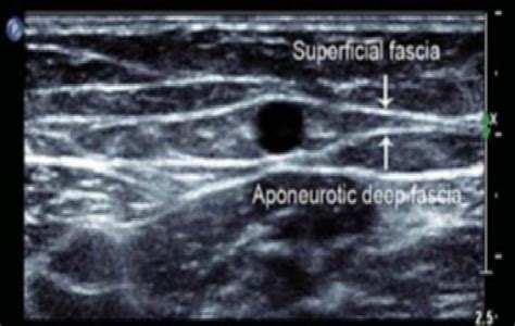 Ultrasound appearance of saphenous vein in the thigh. | Download ...